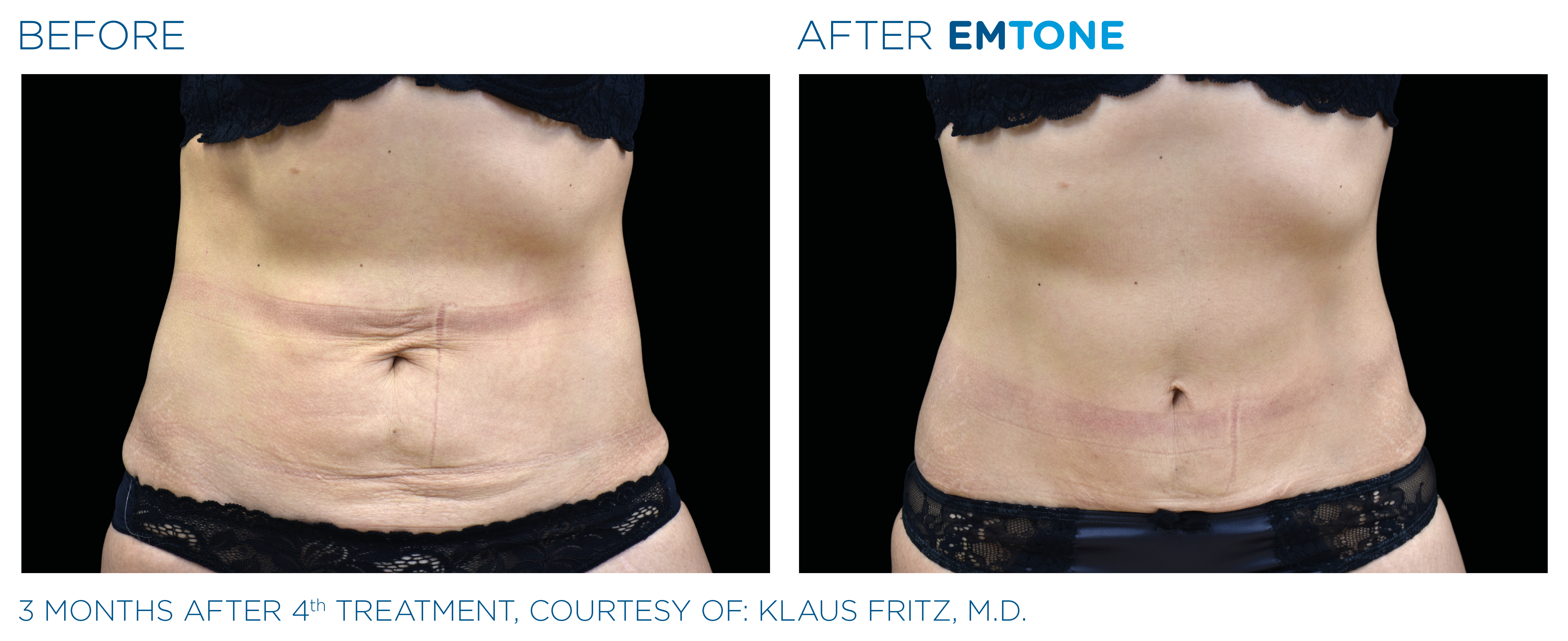 EMTONE előtte-utána 2