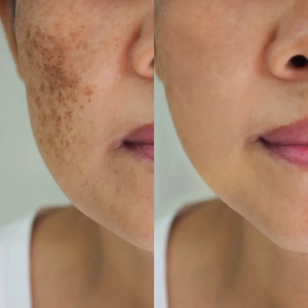 Melasma kezelés