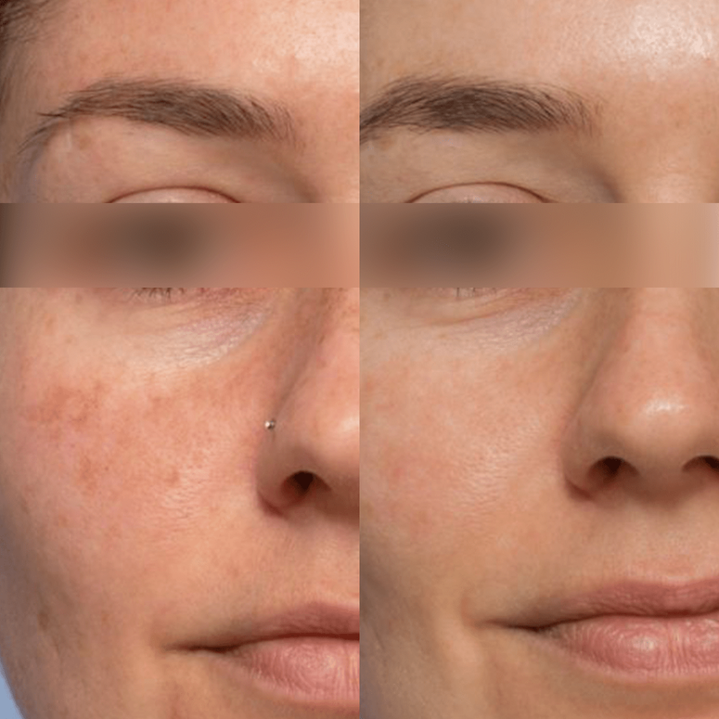 Pigmentfolt kezelés