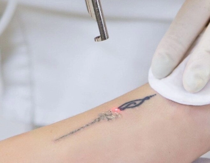 Tetoválás eltávolítás folyamata