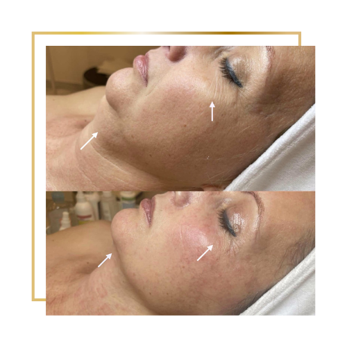 Vivace kezelés előtte-utána eredmény